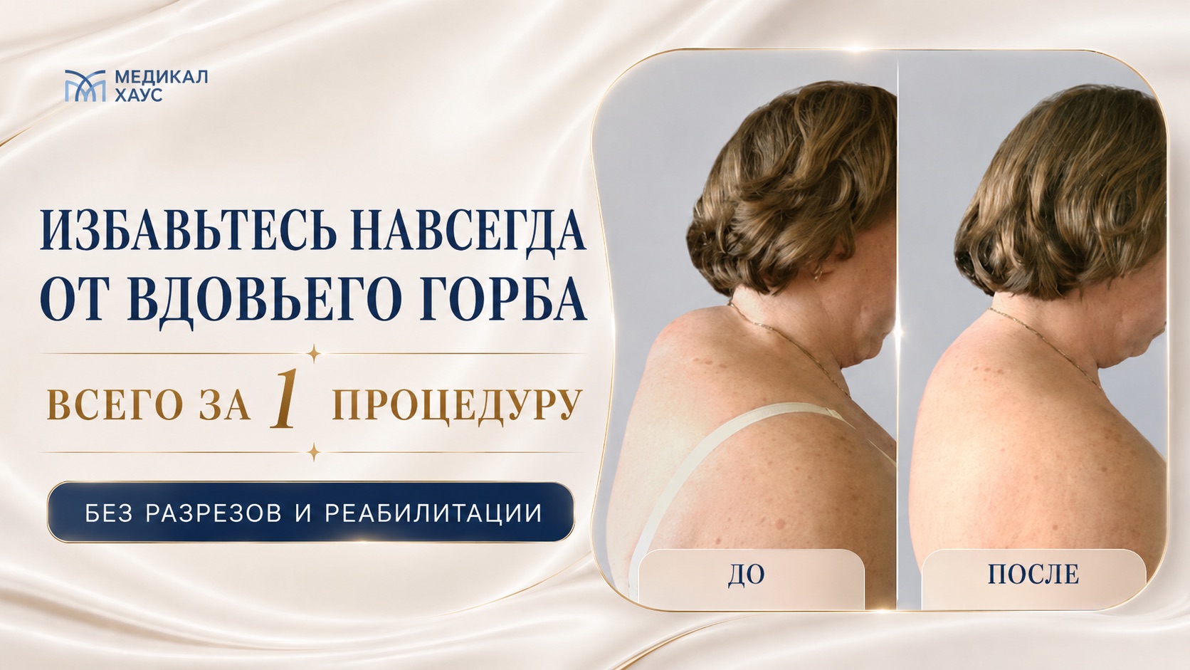 Endolift холки в Medical House