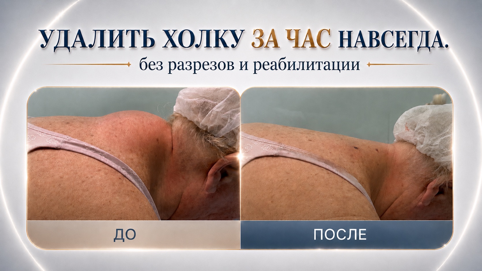 До и после Endolift холки